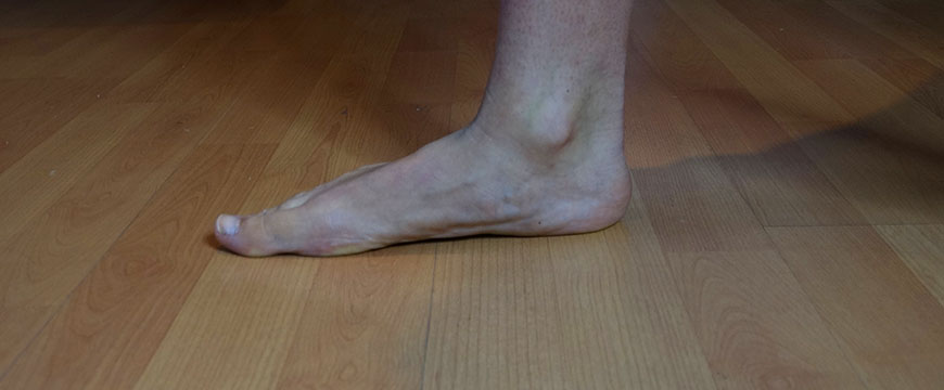 iperpronazione piede